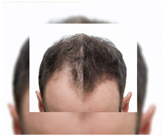 Follixin capsules for hair loss with a thickening and strengthening effect 60 capsules