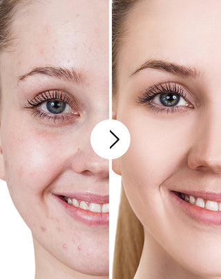 Derminax tablets with zinc and vitamins C, E and B2 for acne, blemishes and imperfections_6 - 5