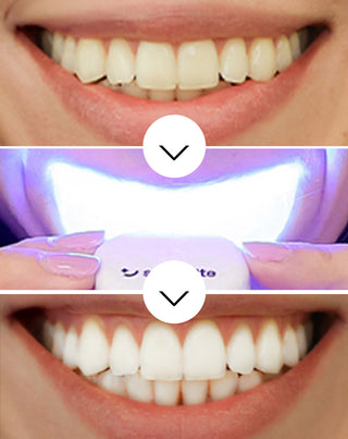 Teeth whitening kit with LED lamp and Light & Bright Smilebite whitening gel