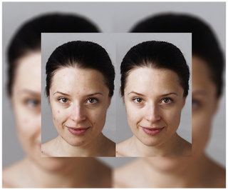 Derminax tablets with zinc and vitamins C, E and B2 for acne, blemishes and imperfections