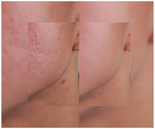 Derminax tablets with zinc and vitamins C, E and B2 for acne, blemishes and imperfections