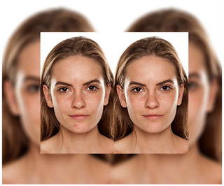 Derminax tablets with zinc and vitamins C, E and B2 for acne, blemishes and imperfections - 6